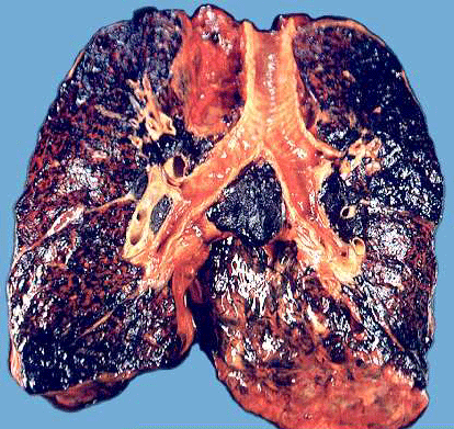 烟民如何预防肺癌  帥哥們吸煙後的肺看起來就是這個樣子？ 還是把菸戒了吧!!!