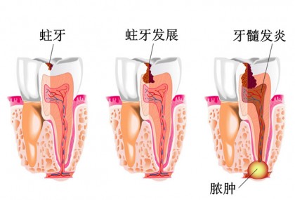 牙脓肿图片